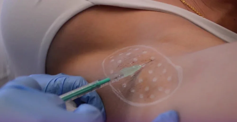 تزریق بوتاکس به زیربغل