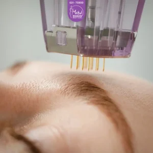 Nearly photo of the woman's forehead with a micronidling machine above it - micronidling