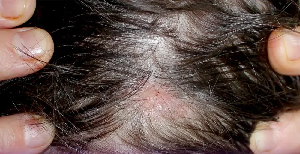 Swelling and redness of the scalp is one of the complications of hair filler injection