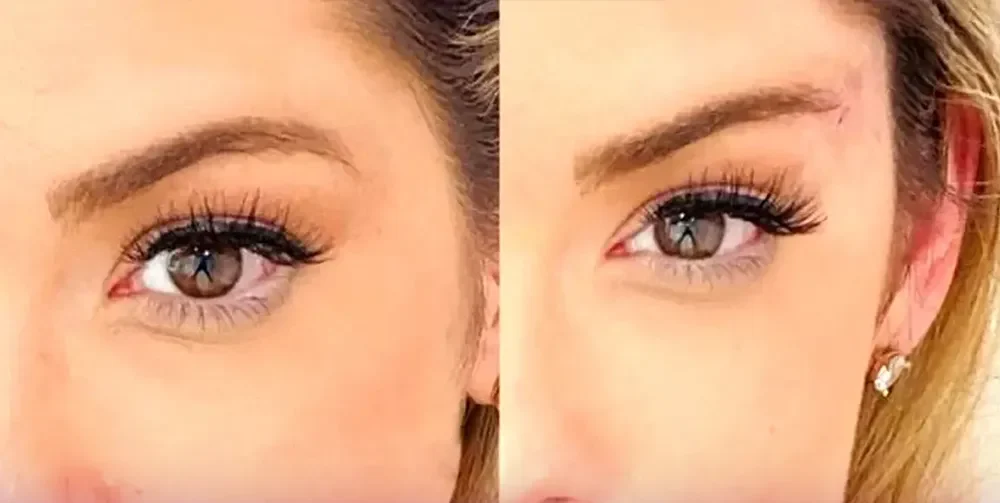 قبل و بعد از انجام لیفت شقیقه