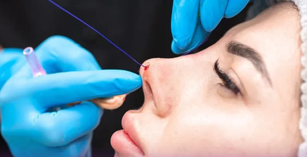 Dịch vụ thu gọn cánh mũi đẹp và giá rẻ tại TPHCM 12 Nose Thread Lift | Non-Surgical Nose Reshaping & Contouring