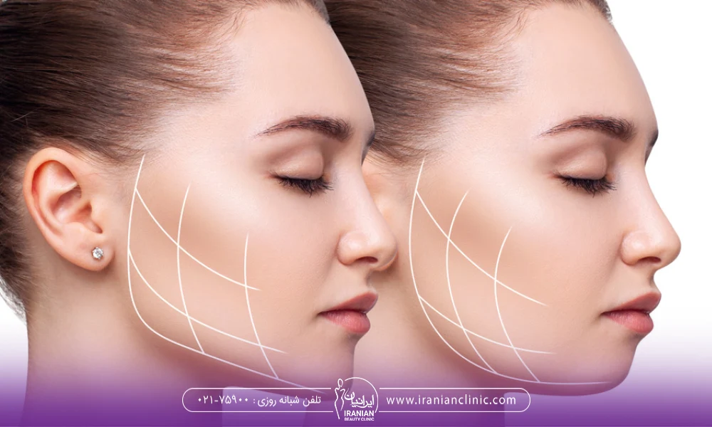 The Impact of Buccal Fat Removal on Facial Appearance