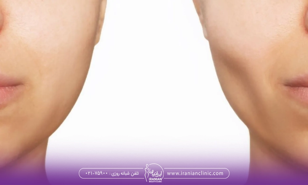 How Long Does Buccal Fat Removal Last?