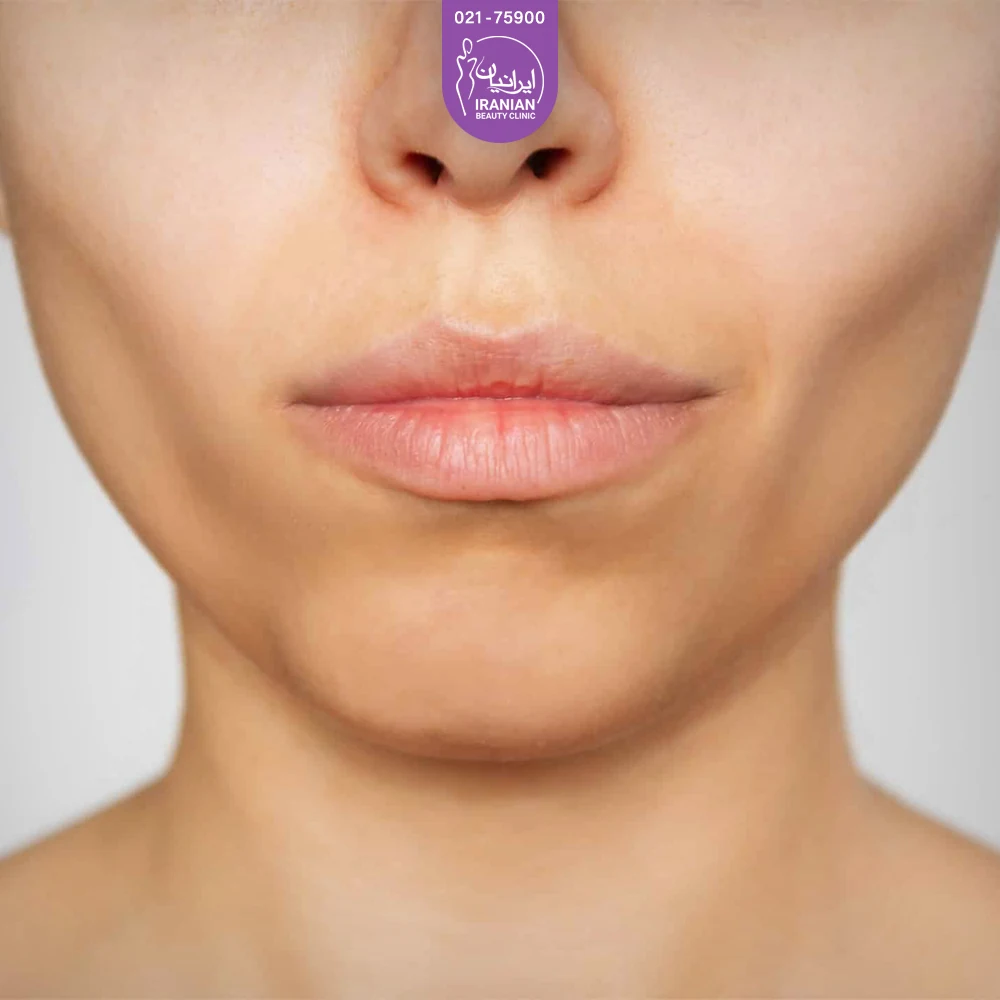 Buccal Fat