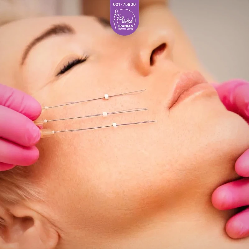 عکس نخ لیفت روی صورت زن جوان