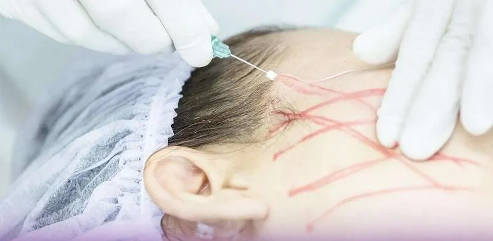 پزشک در حال وارد کردن نخ لیفت داخل پوست صورت مراجعه کننده زن