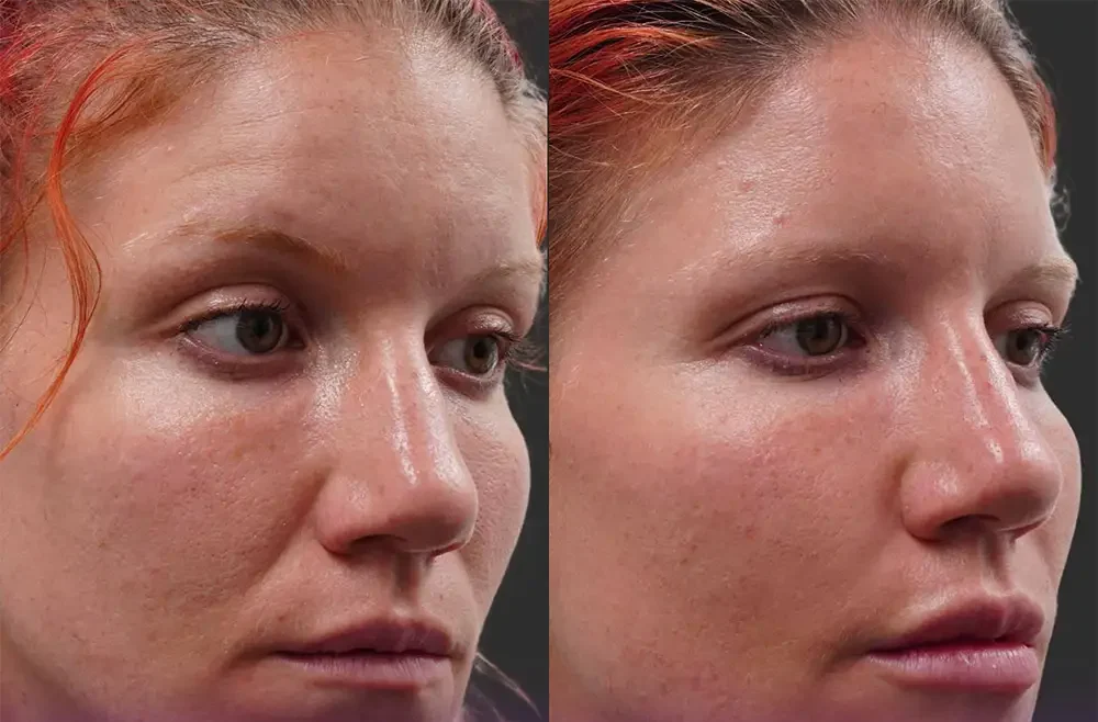 Before and after photos of Botox smile lines - Botox injections for smile lines