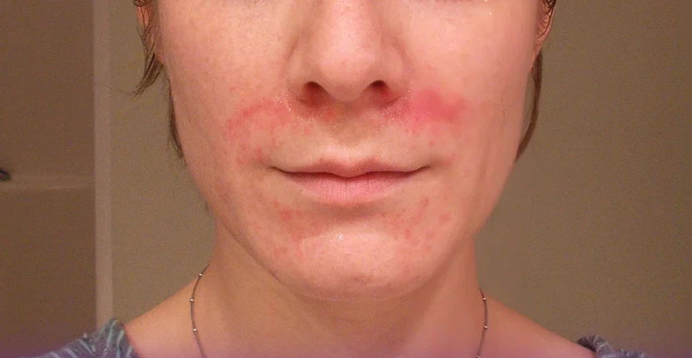 Redness of the laugh line after Botox injection is one of the side effects of this procedure.