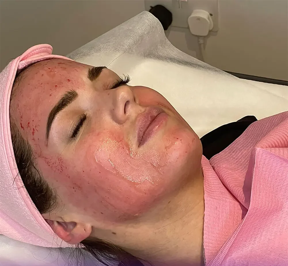 عکس صورت دختر که بعد از مزونیدلینگ قرمز شده و ورم کرده است - مزونیدلینگ