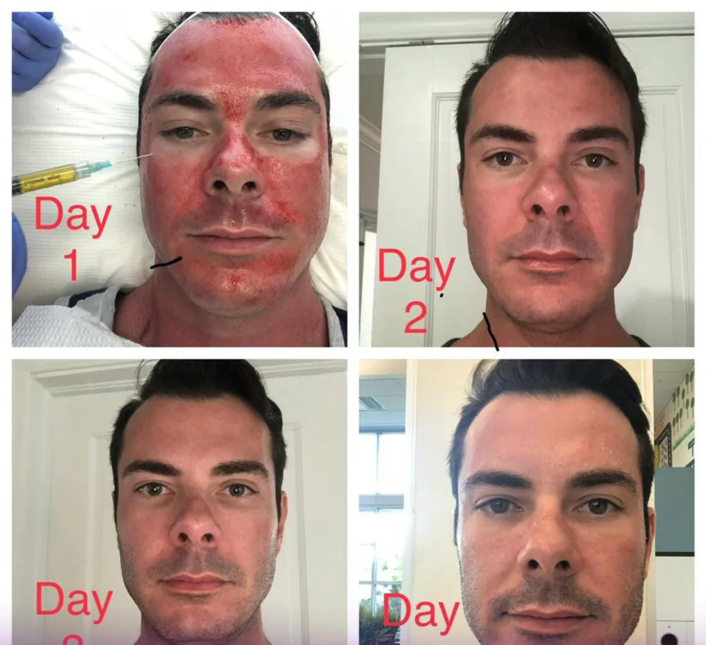 Photos of different days after PSP injection