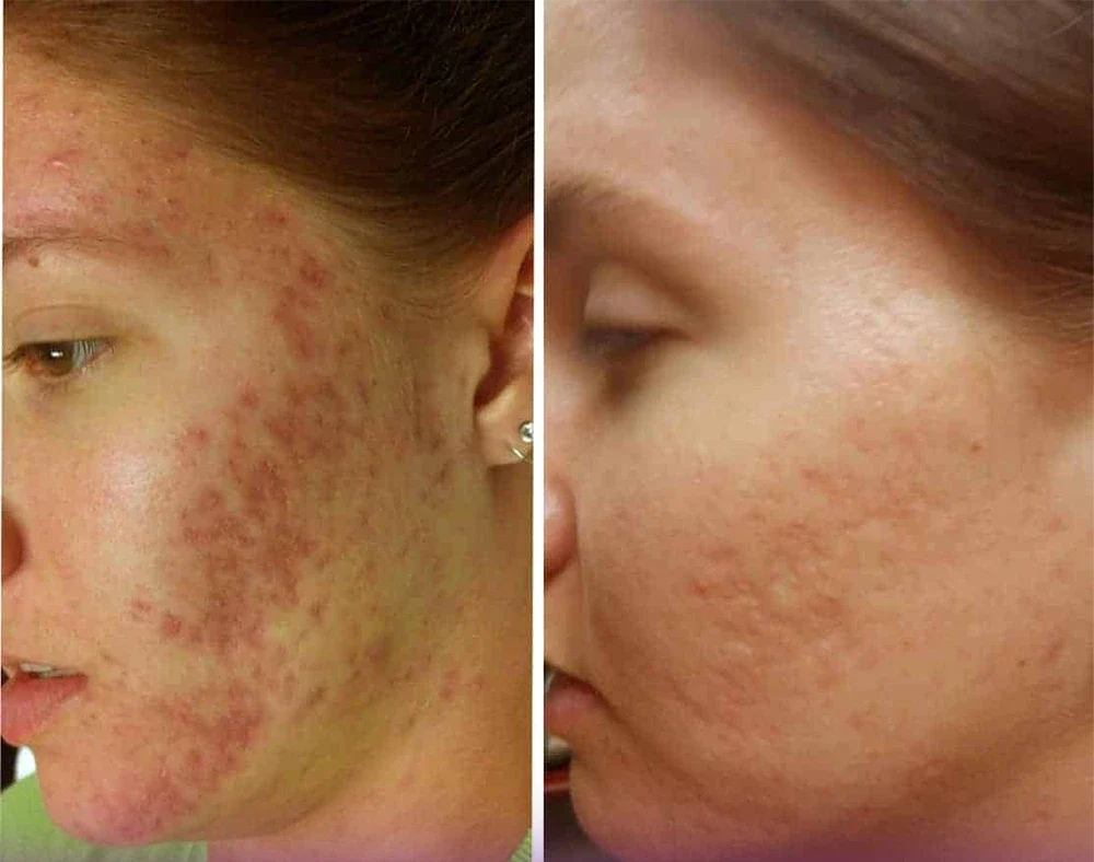 عکس قبل و بعد مزونیدلینگ جوش صورت که باعث شده جوش های صورت دختر از بین برود