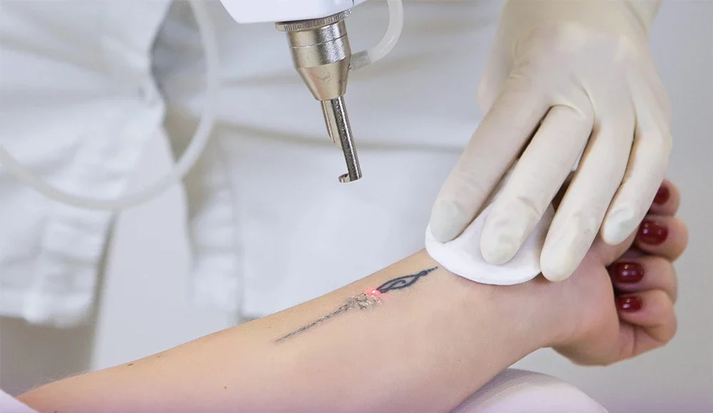 Laser operator removing tattoo from girl's forearm