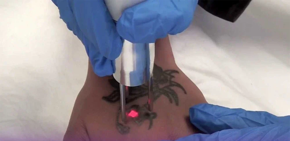 Q-switch laser operator removing a tattoo on a hand