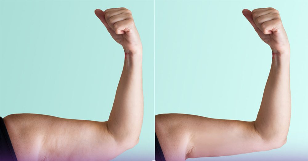 عکس قبل و بعد هایفو بازو