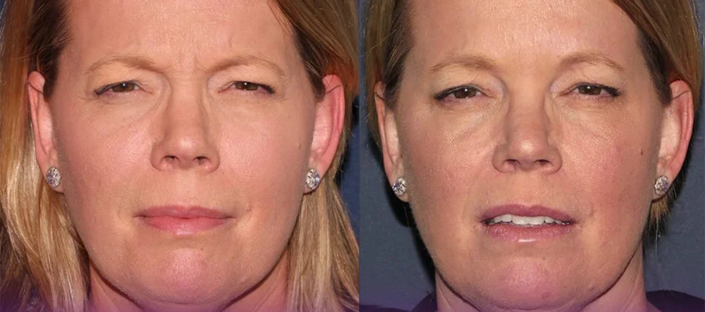 Before and after Botox Female Line