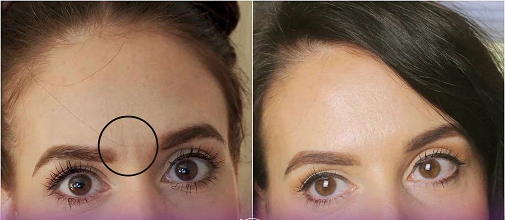 Photo before and after a girl who had a frown line and then fixed with the frown Botox