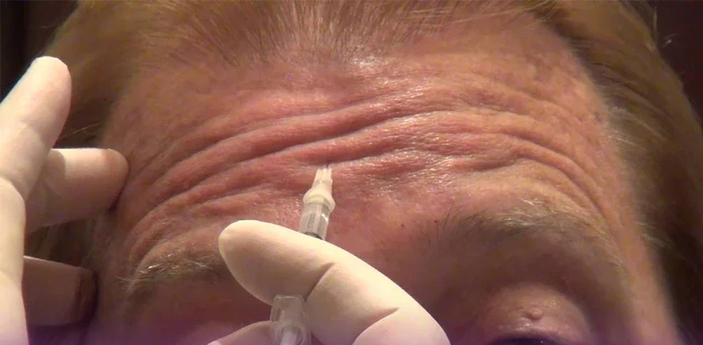 A man's forehead that contracts his forehead and the doctor injects his Botox forehead