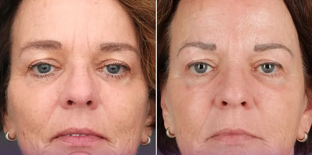 Photo before and after injecting Botox Line to the woman's forehead