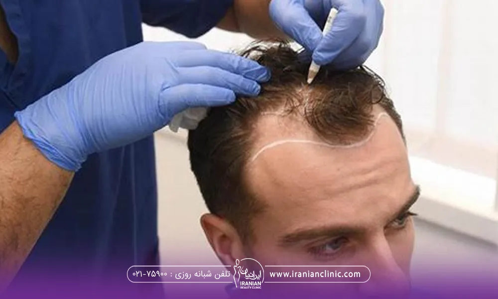 Who Is a Good Candidate for Temple Hair Transplant?