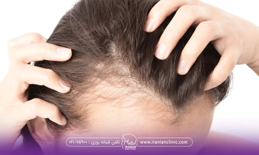 What Is a Temple Hair Transplant?