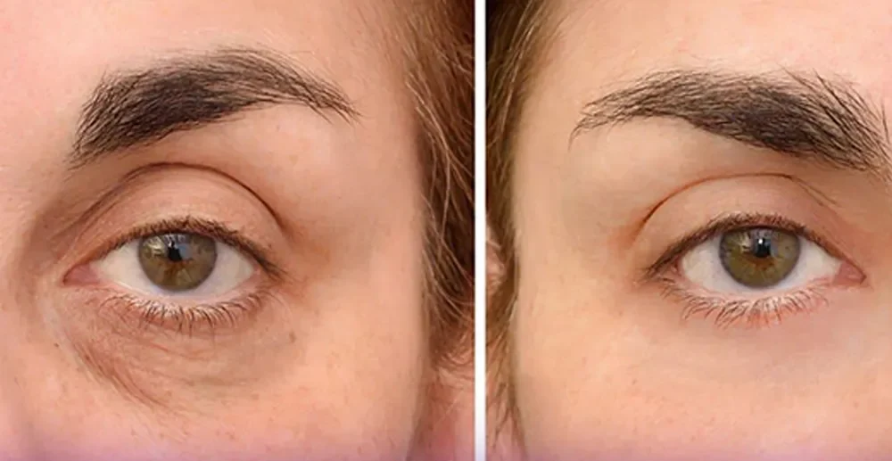 Picture before and after the person who has done Botox under the eyes - Botox Injection around the Eye
