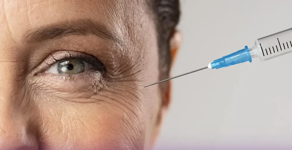 A woman who has the corner of her eyes has a clean line and the Botox syringe holds beside her eyes