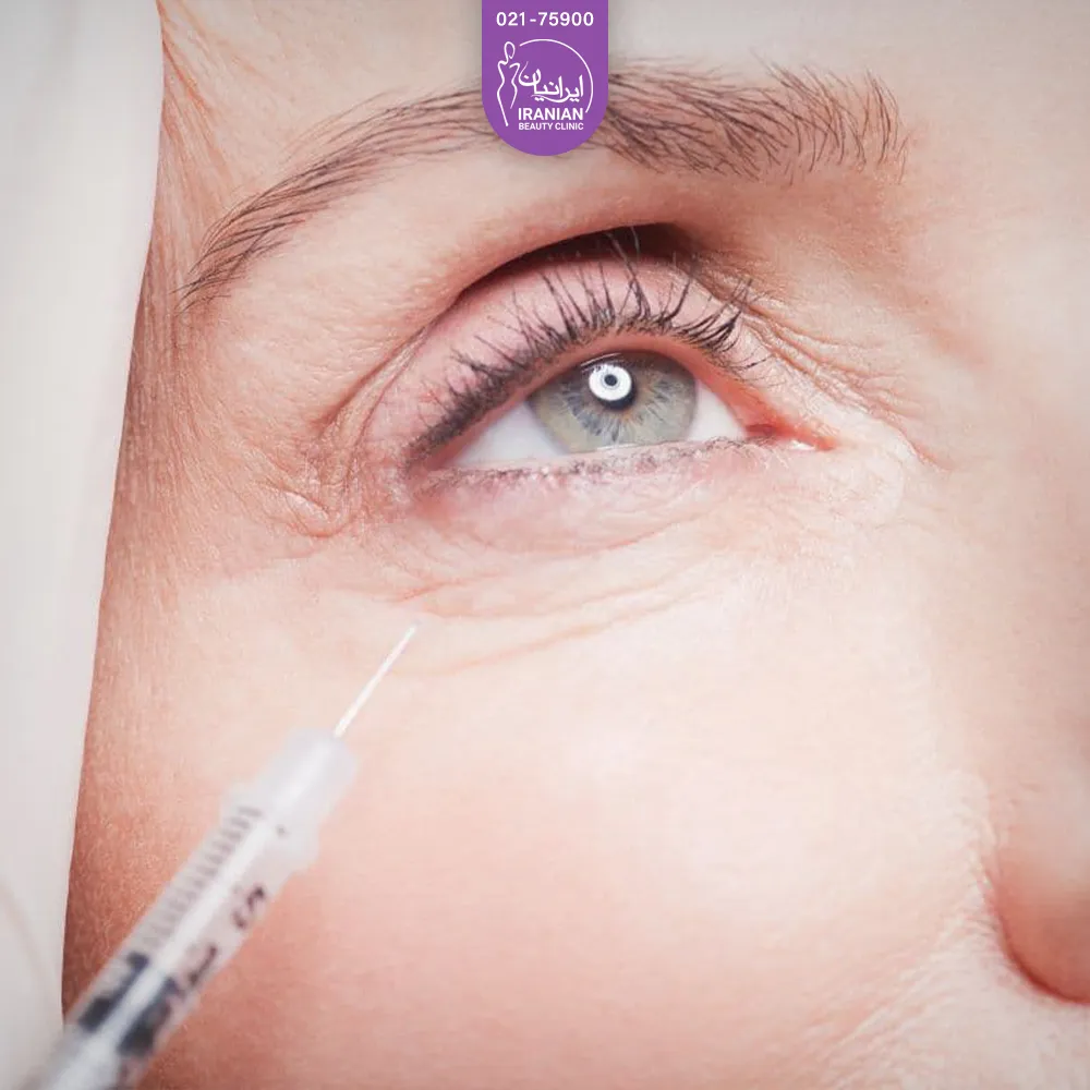 The eye and eyebrows of the person looking upwards and the syringe is taken near his eye - Botox injection around the eye