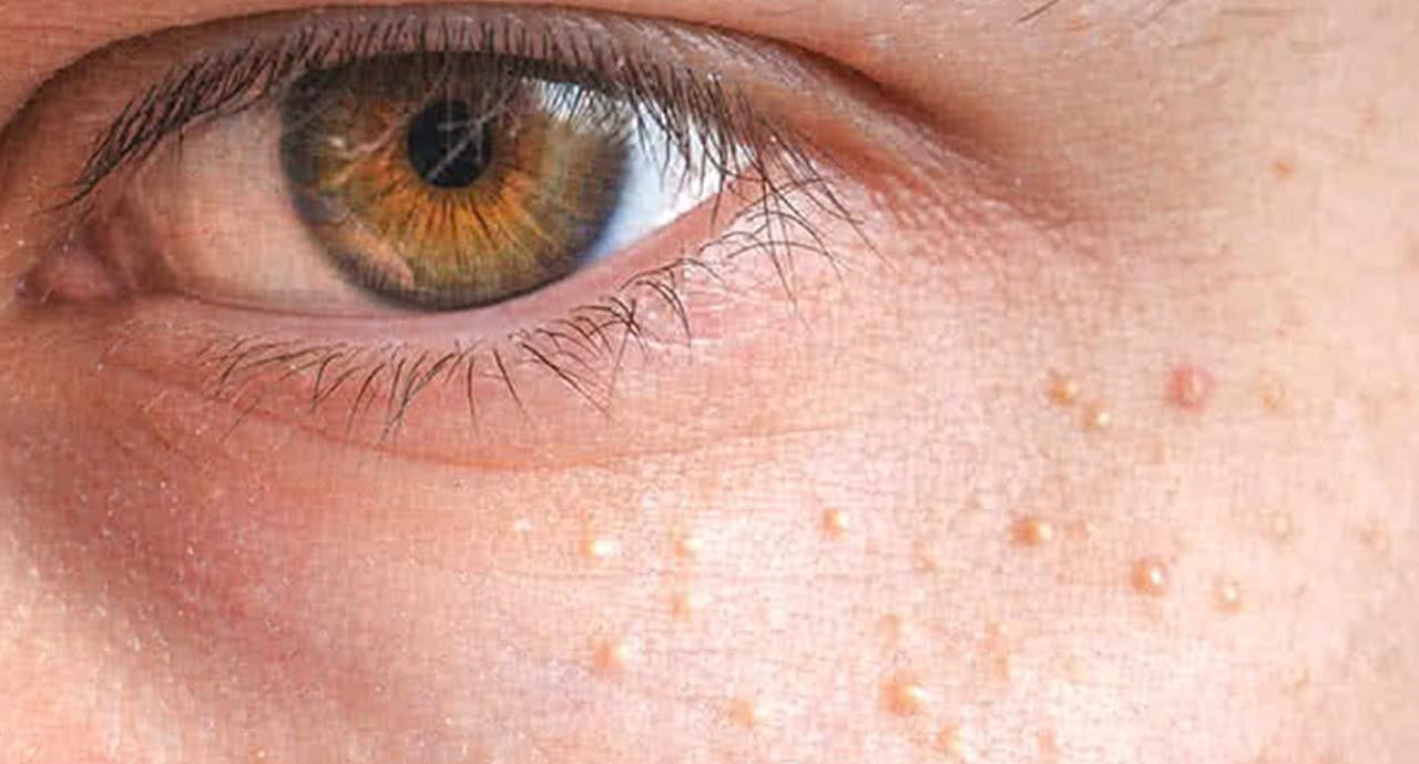 جوش زیر پوستی - درمان خانگی میلیا چشم