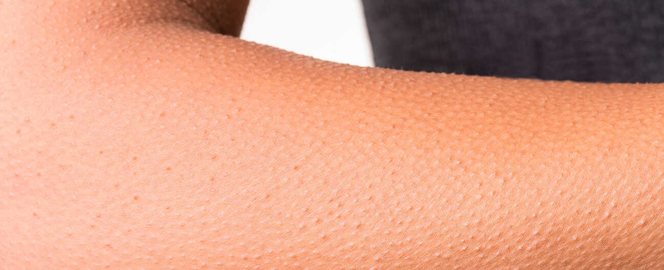 علائم پوست مرغی - درمان پوست مرغی