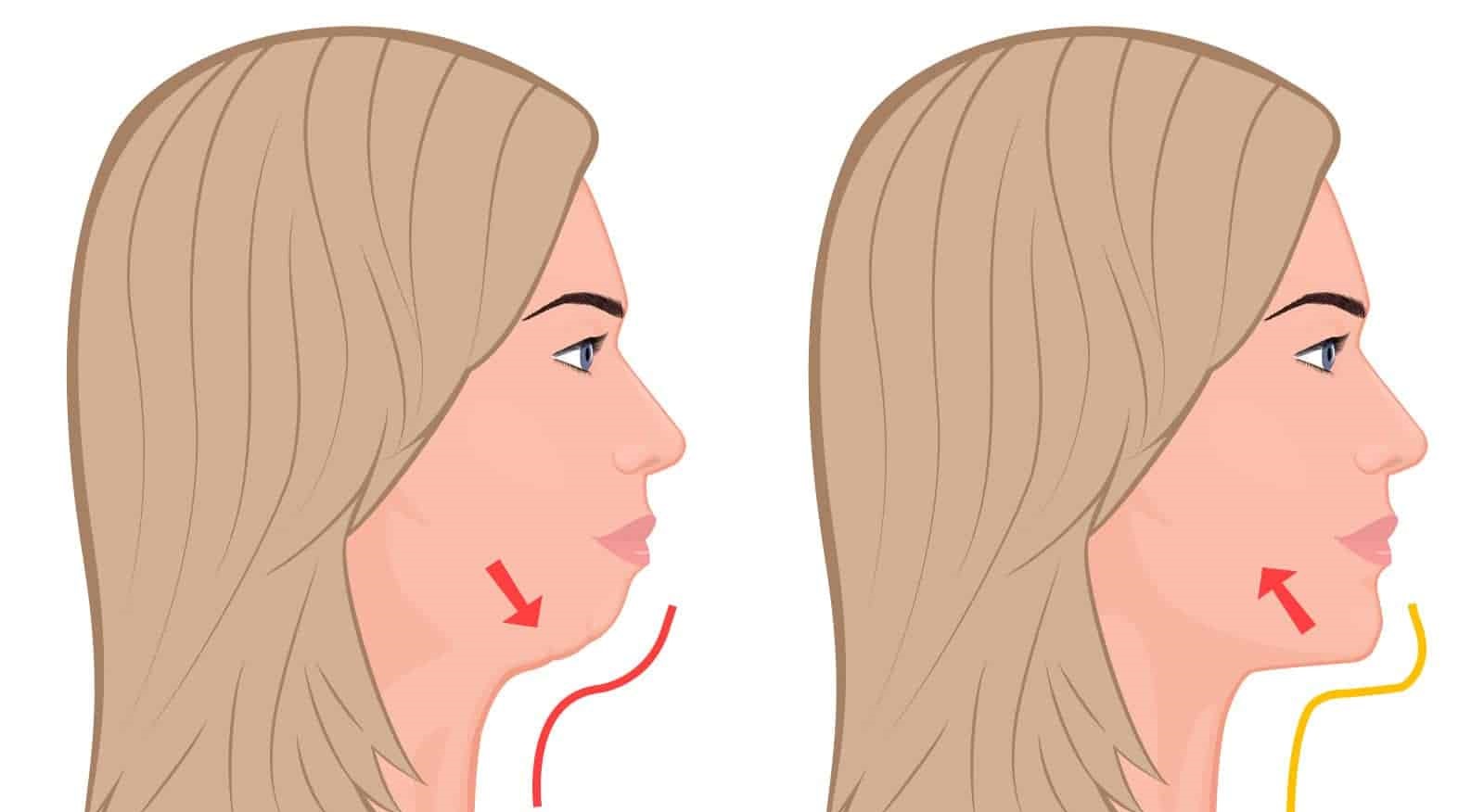 علت ایجاد غبغب - از بین بردن غبغب