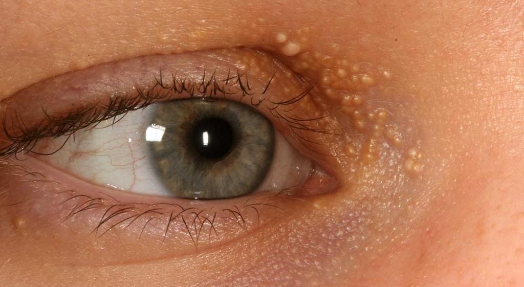 میلیا شدید دور چشم - درمان خانگی میلیا چشم