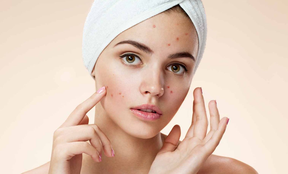 جوش سر سیاه - از بین بردن جای جوش