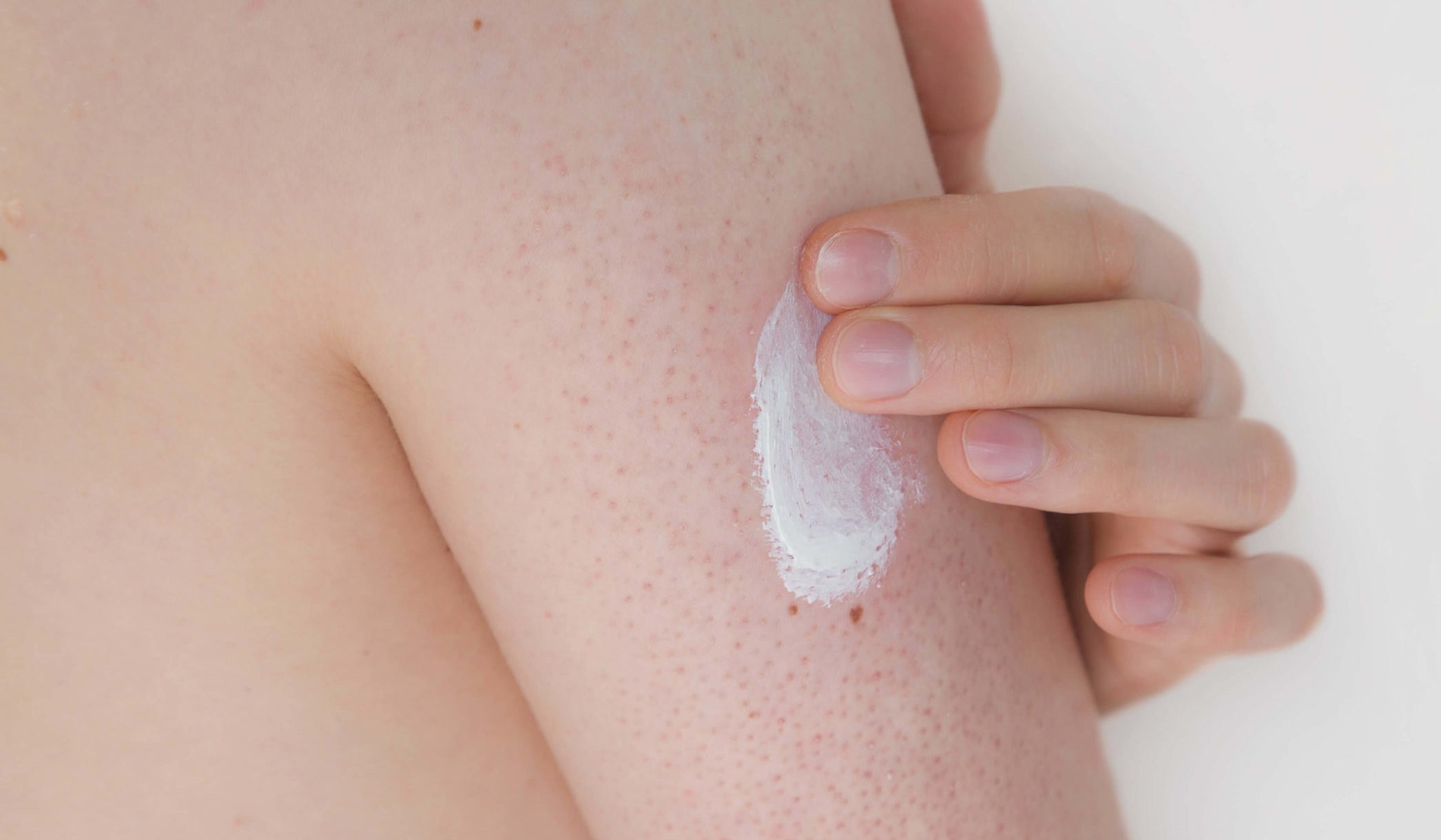 پوست مرغی بازو - درمان پوست مرغی