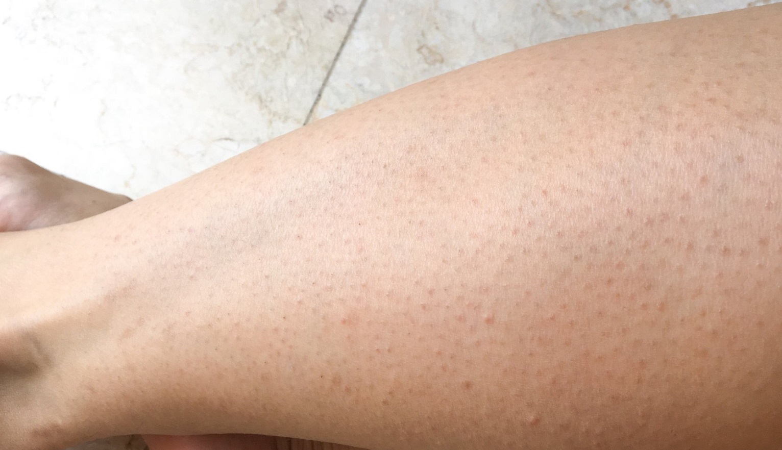 پوست مرغی ساق پا - درمان پوست مرغی