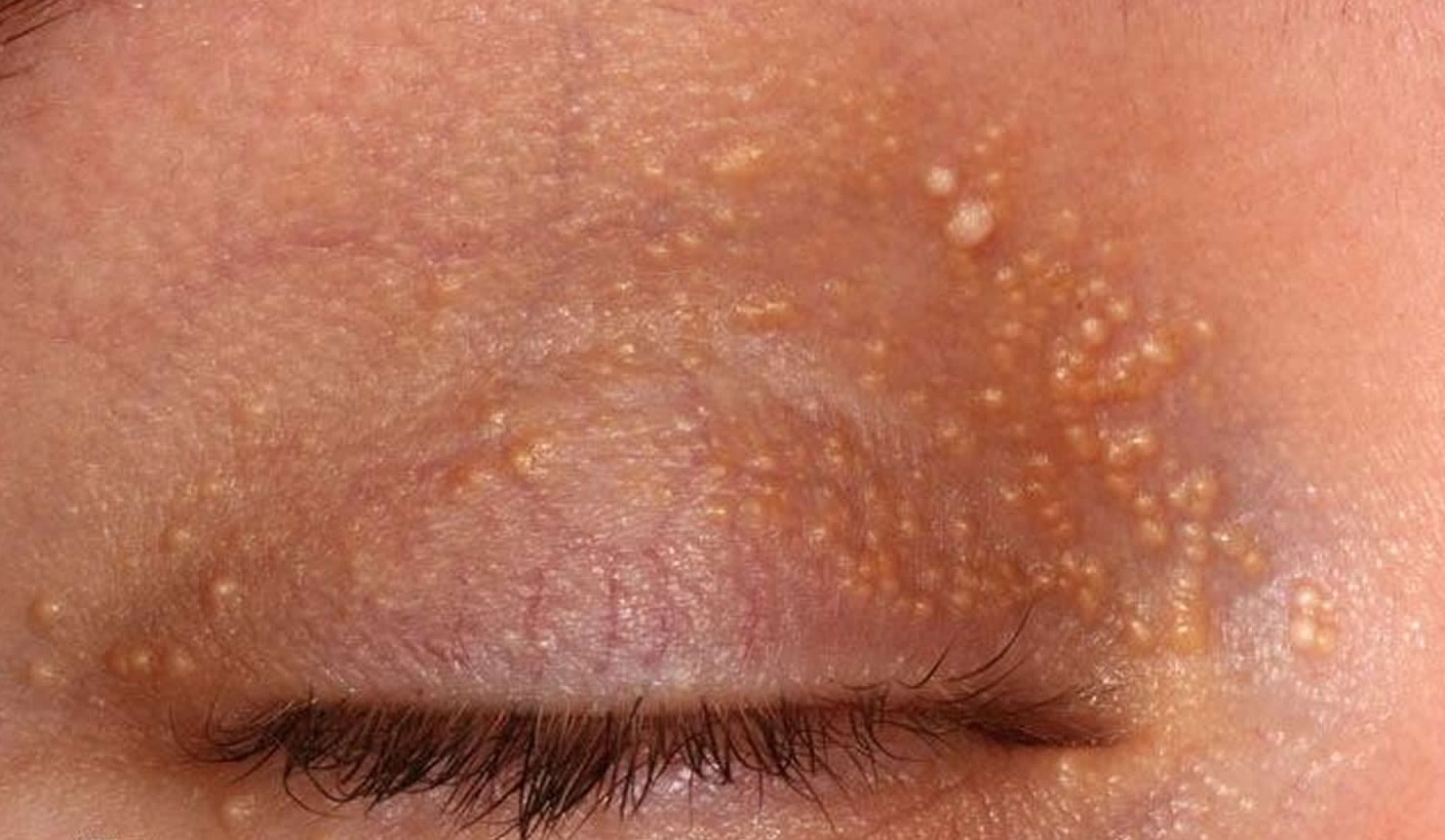 میلیا پشت پلک - درمان خانگی میلیا چشم