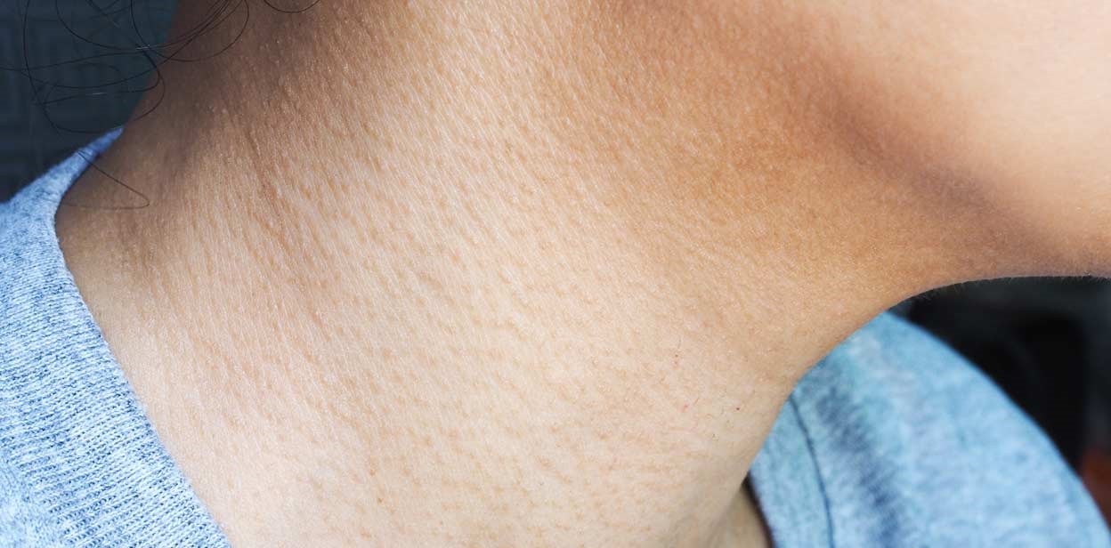 پوست مرغی گردن - درمان پوست مرغی