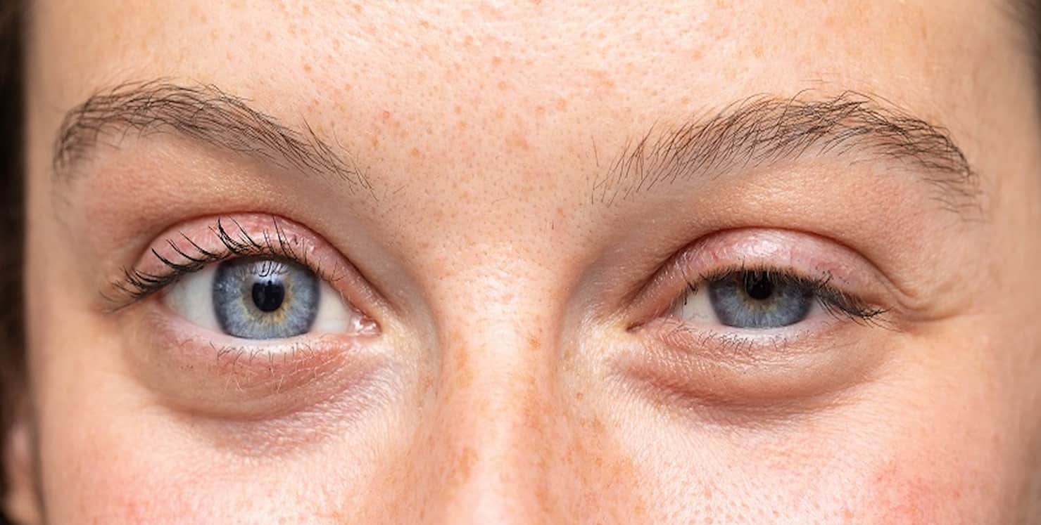 افتادگی شدید پلک = آرایش پلک افتاده