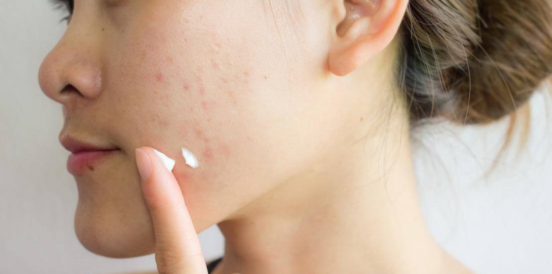 کرم ضد جوش - از بین بردن جای جوش