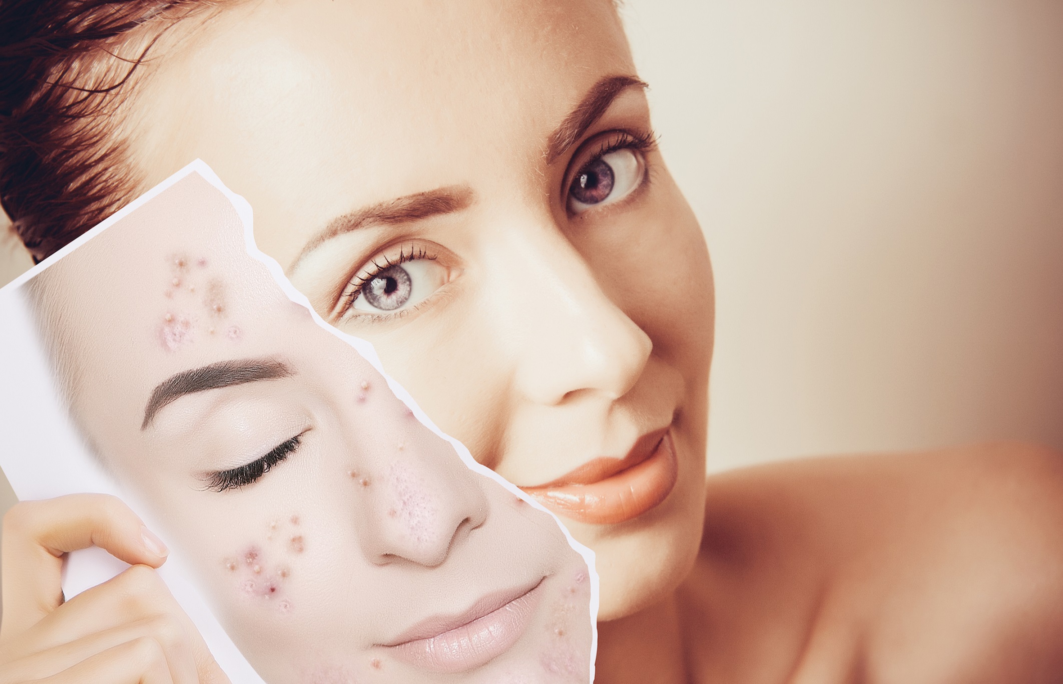 جوش های چرکی صورت - از بین بردن جای جوش