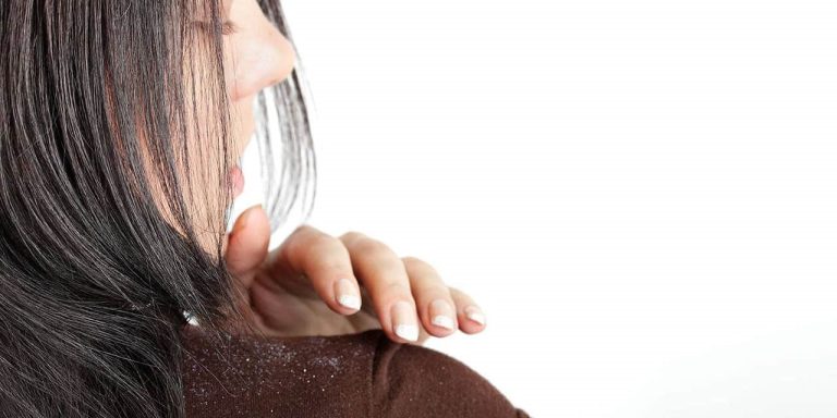 درمان موهای چرب و شوره دار