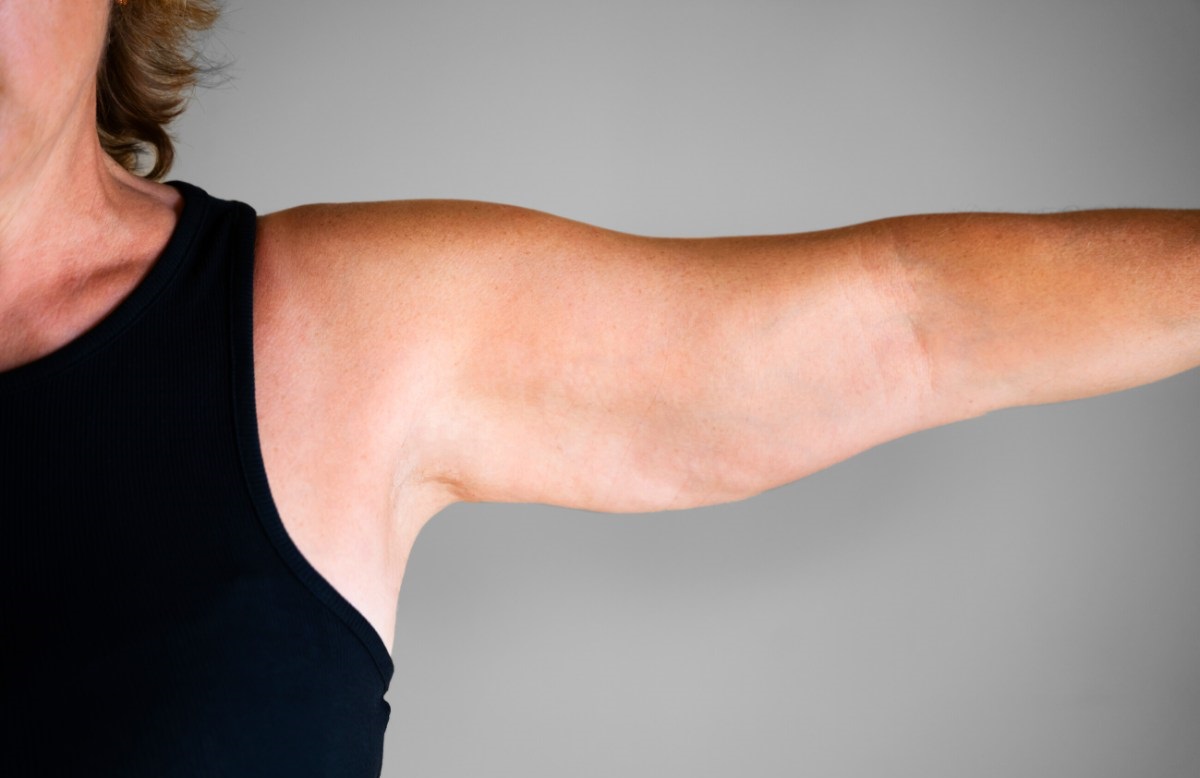 درمان افتادگی بازو - رفع شلی بازو