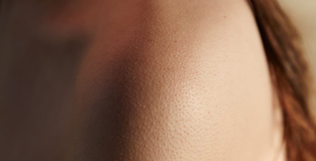 پوست مرغی شانه - درمان پوست مرغی