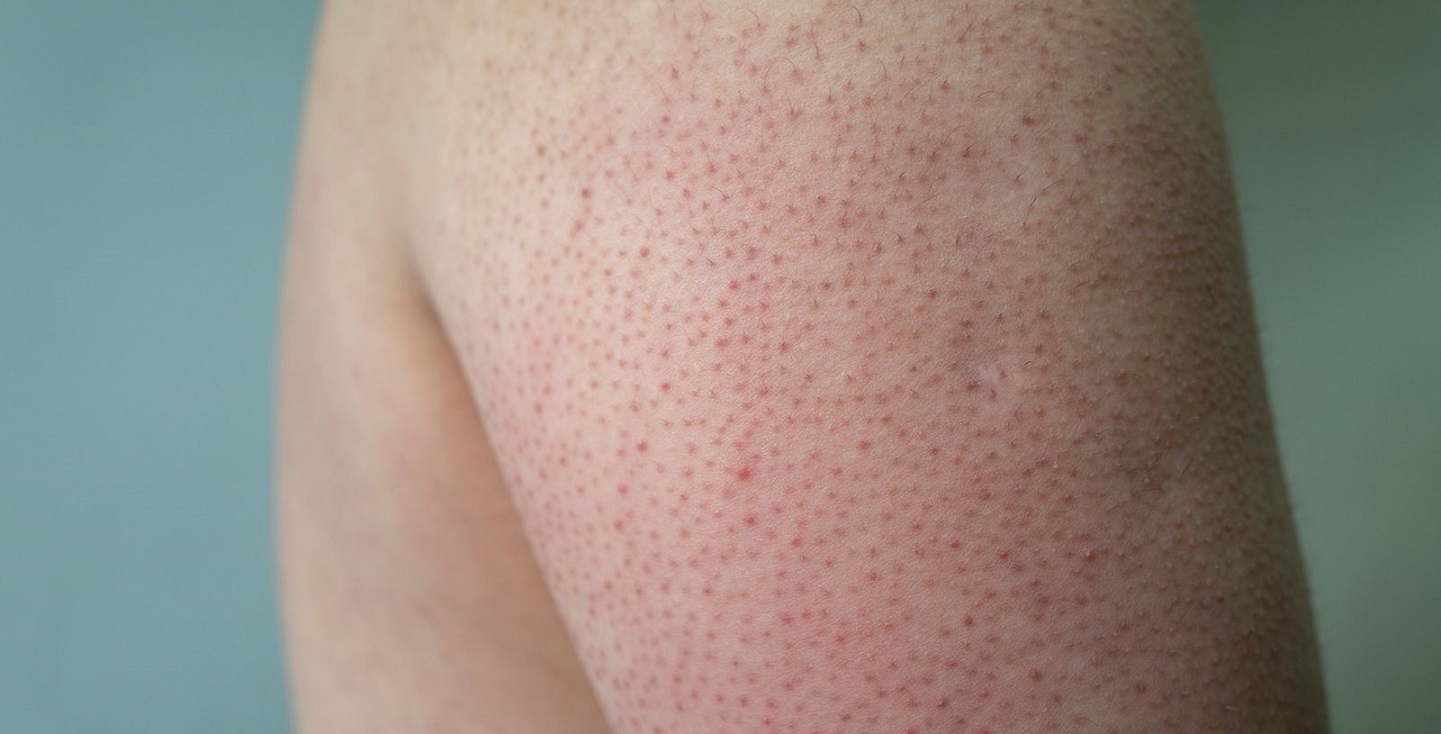 جوش های قرمز بازو - درمان پوست مرغی