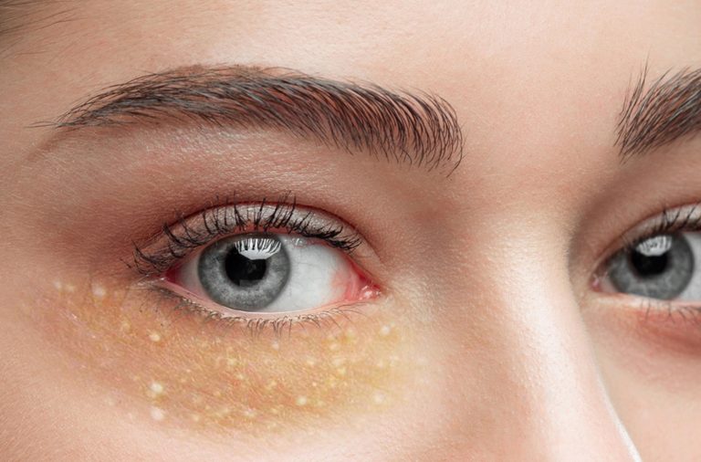 درمان خانگی میلیا چشم