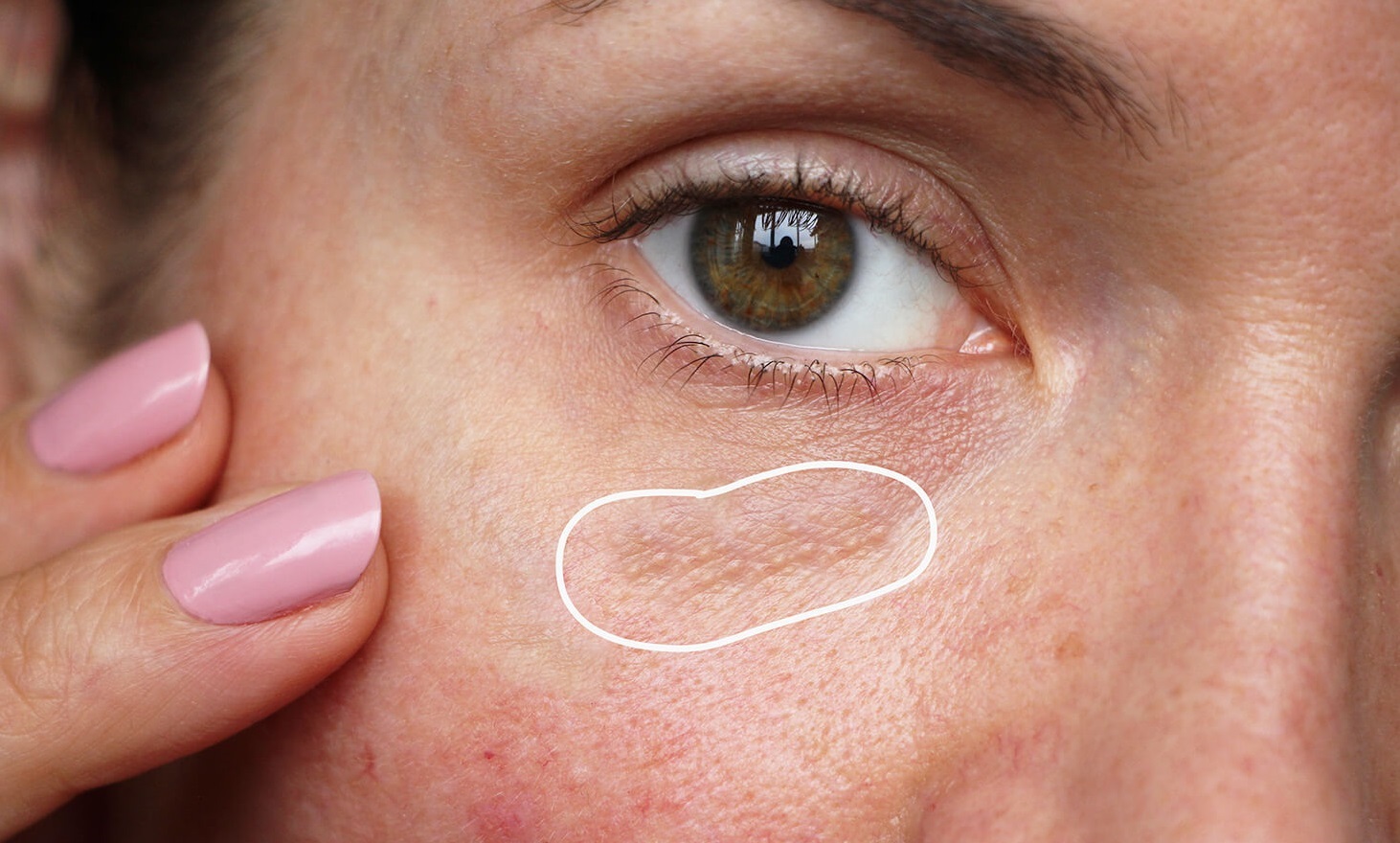 جوش زیر چشم - درمان خانگی میلیا چشم