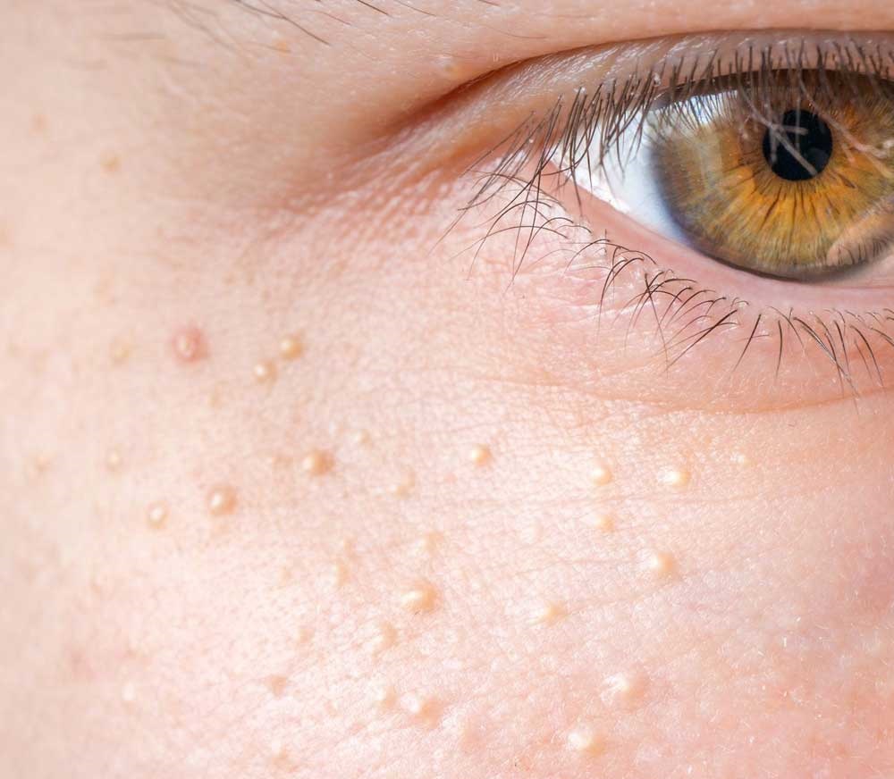 لیزر کردن میلیا چشم - درمان خانگی میلیا چشم