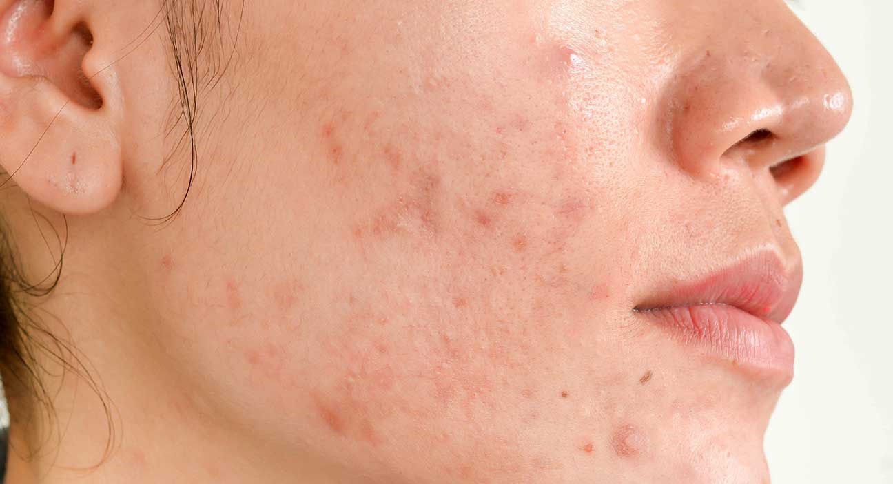 آکنه - از بین بردن جای جوش