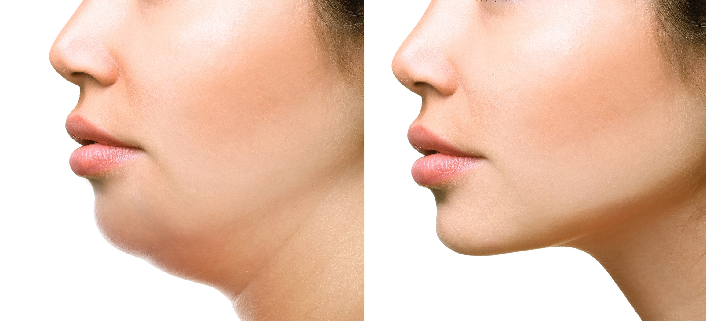 رفع غبغب - از بین بردن غبغب