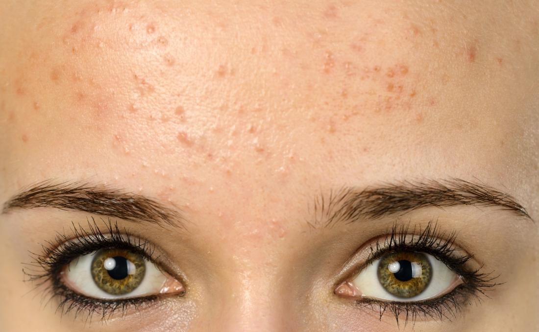 جوش پیشانی - از بین بردن جای جوش