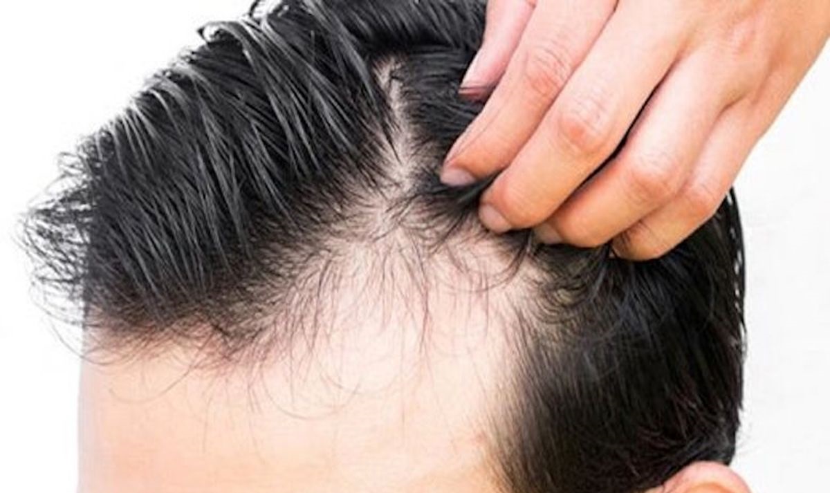 کچلی - درمان ریزش مو